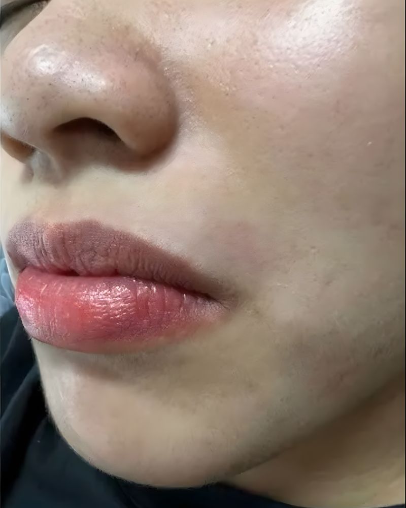 After Tiến trình triệt lông