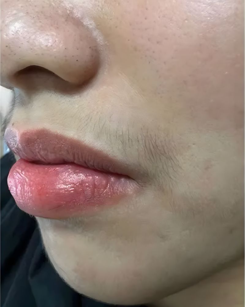 Before Tiến trình triệt lông